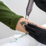 How To Get Laser Tattoo Removal