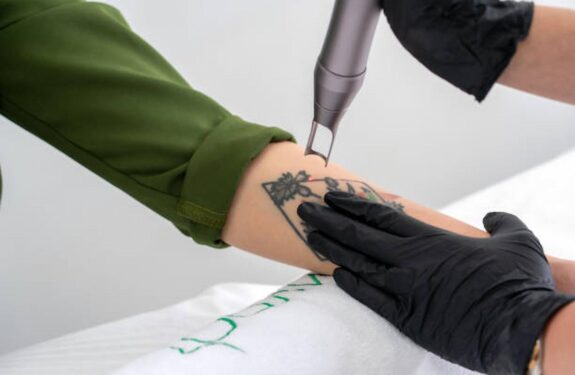 How To Get Laser Tattoo Removal